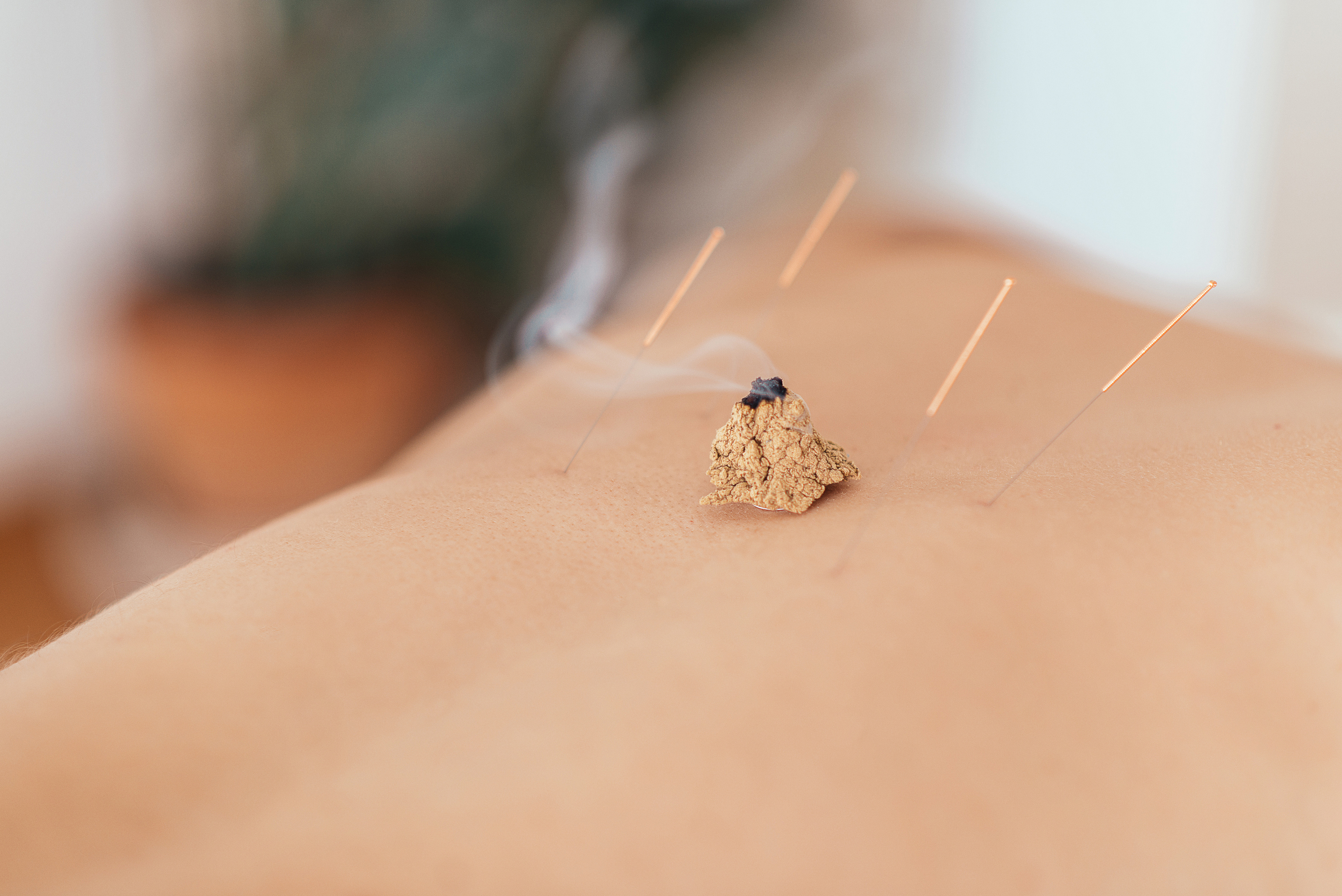 Acupuncture and moxibustion treatment