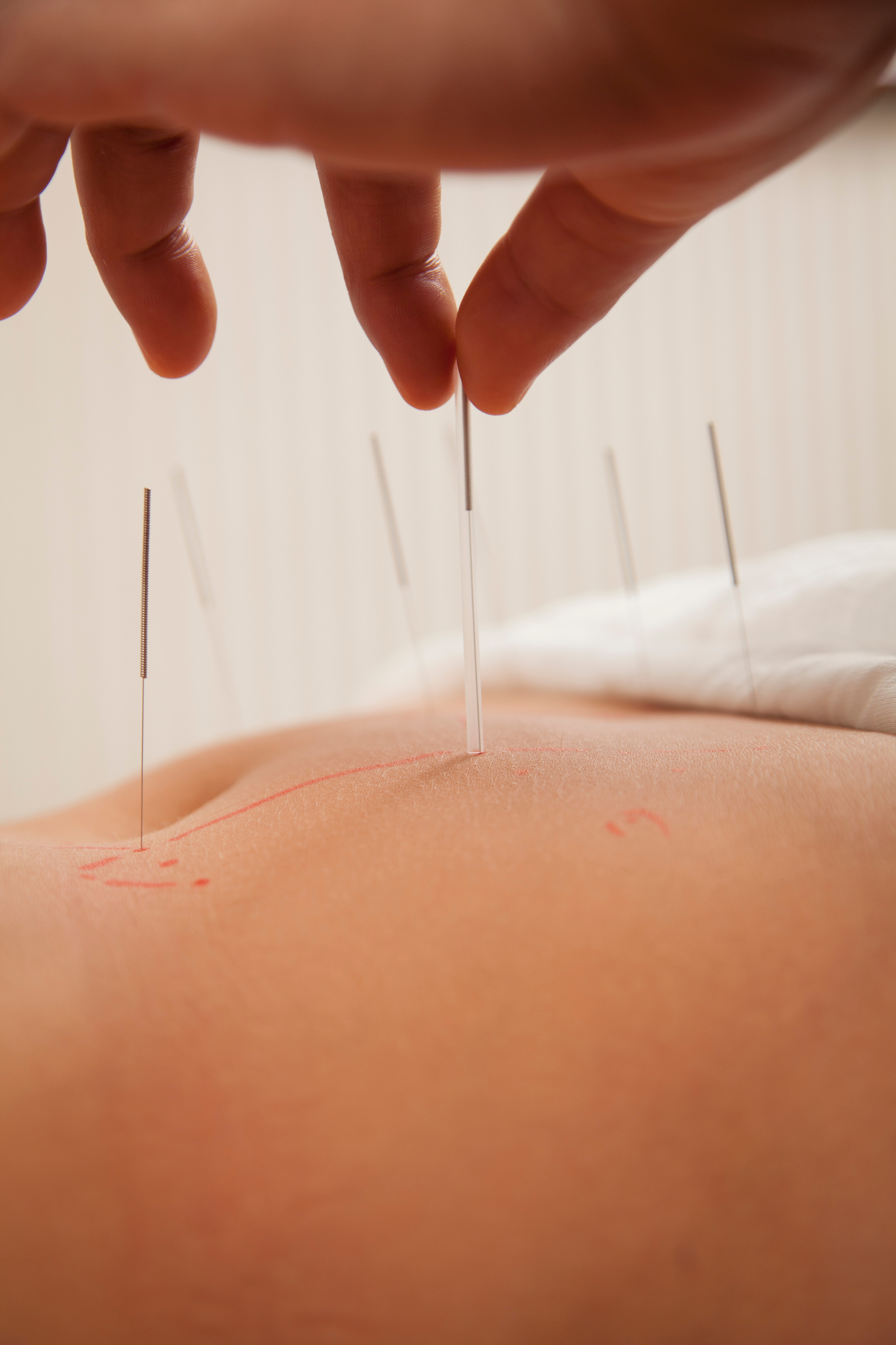 Acupuncture