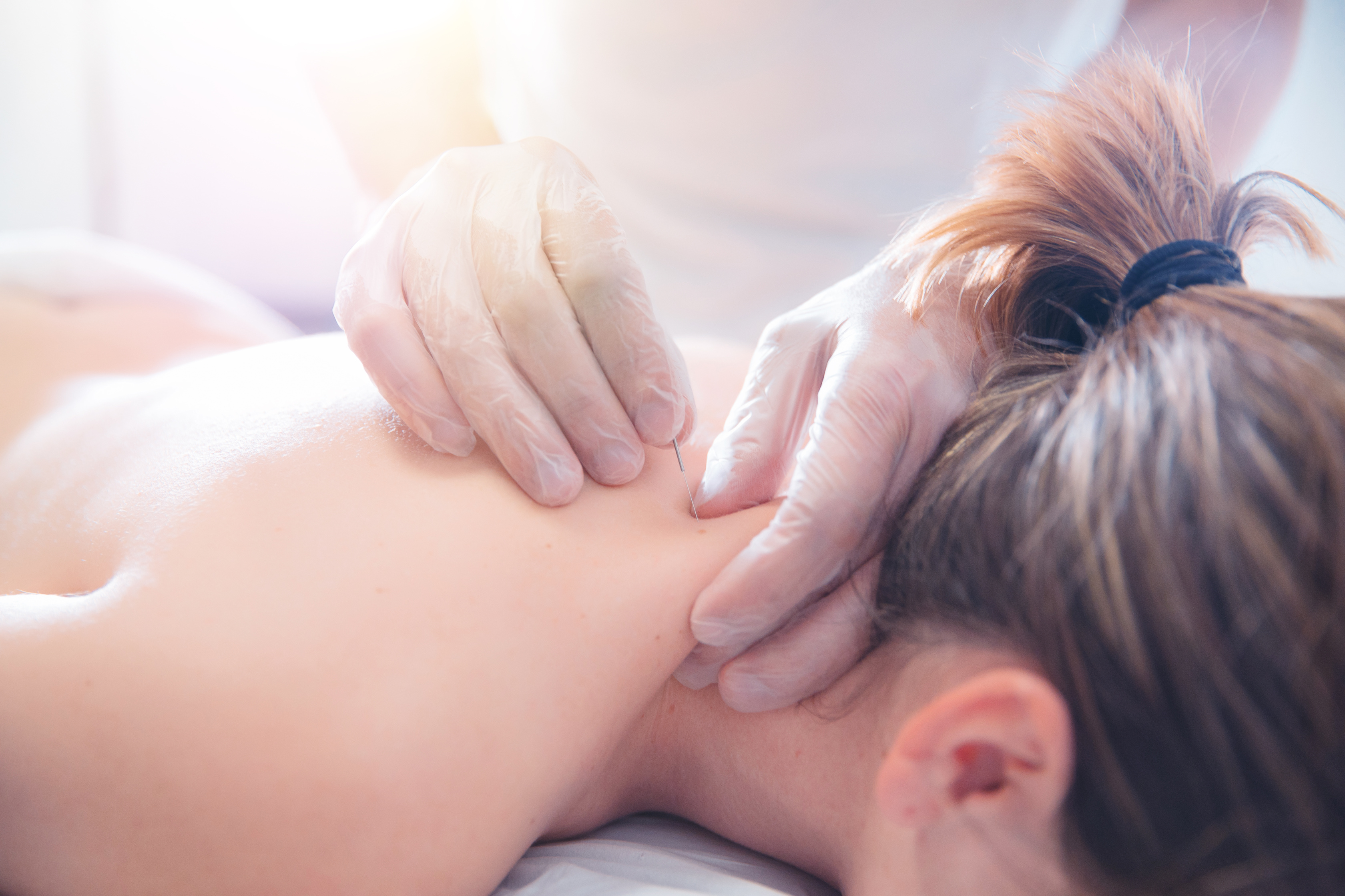 Physiotherapist doing acupuncture to a young woman on her back