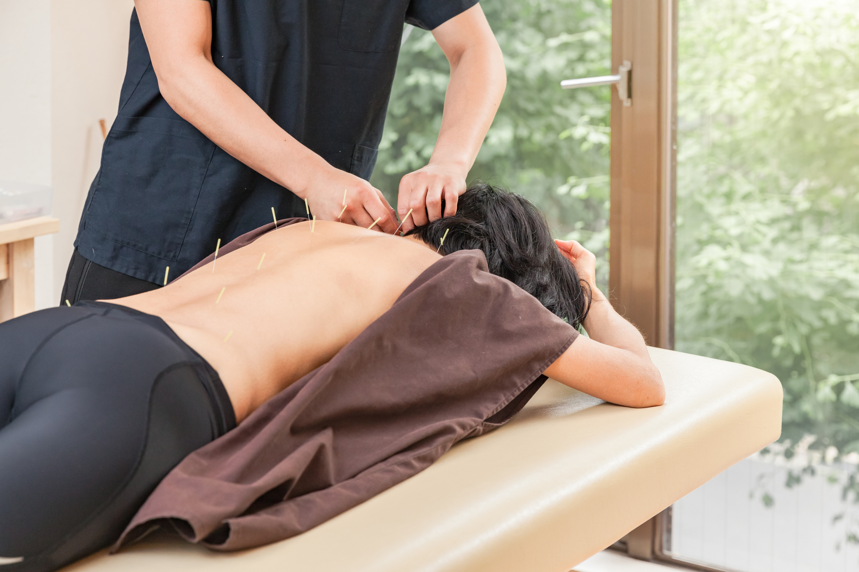 Acupuncturist sticking acupuncture needles